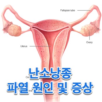 난소낭종을 알수 있는 여성의생식기관 모형도